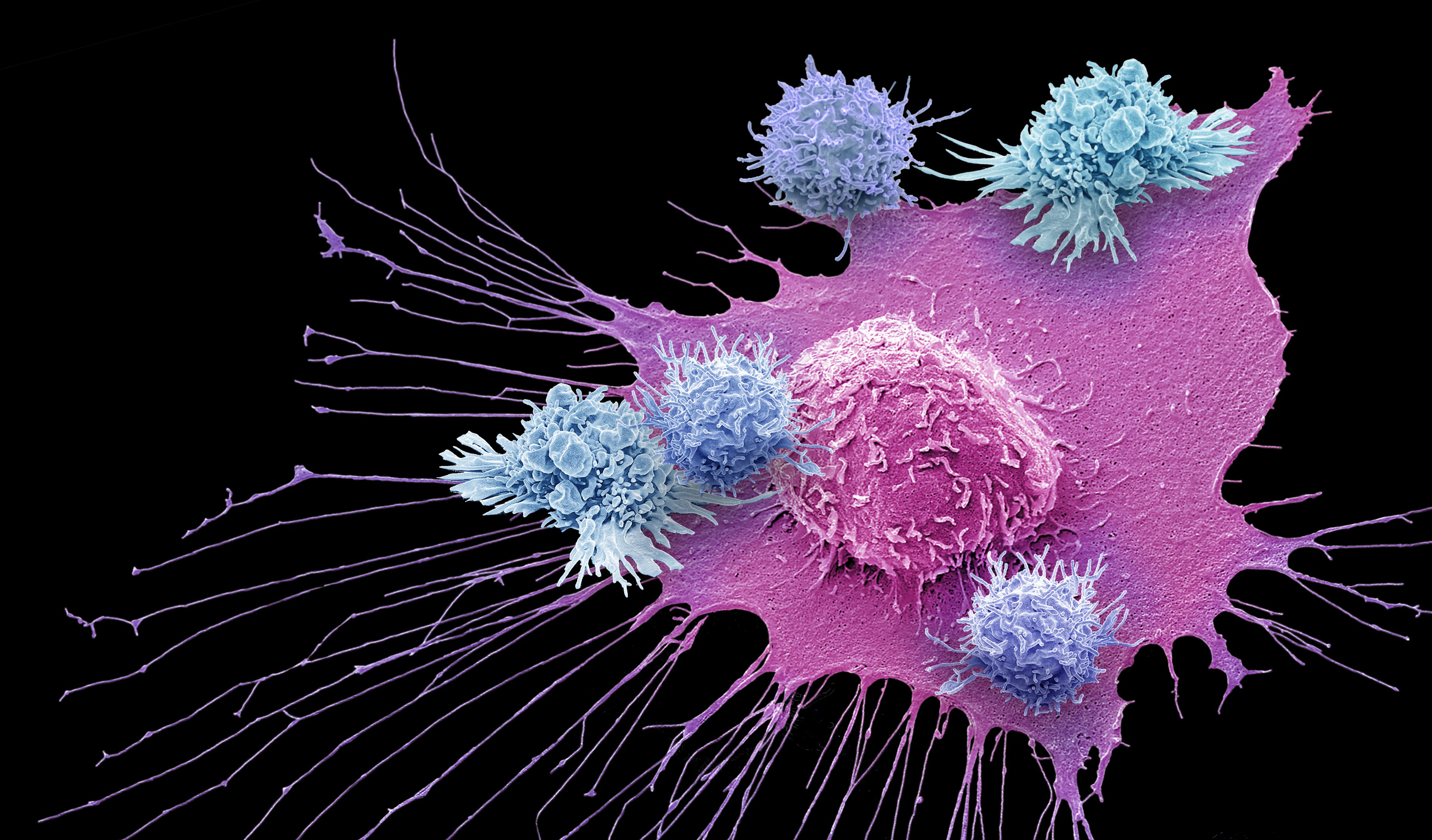 Вакцина дендритными клетками. Т-лимфоцит атакует раковую клетку. Дендритные клетки микробиология. Раковые клетки микроскопия. Раковая клетка и т лимфоцит.